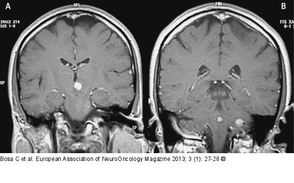 Brain MRI
