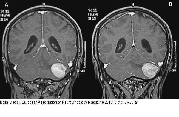 Brain MRI