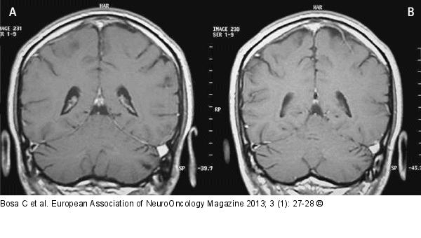 Brain MRI