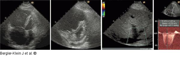 Primr pulmonale Hypertonie