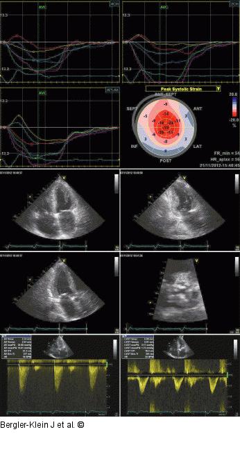 Low-flow-Aortenstenose