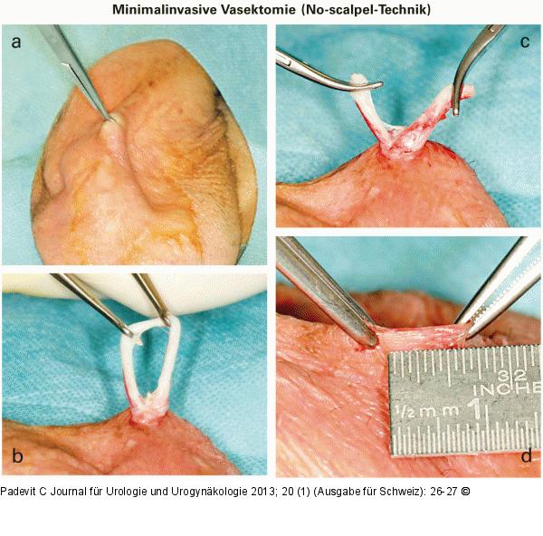 Minimalinvasive Vasektomie