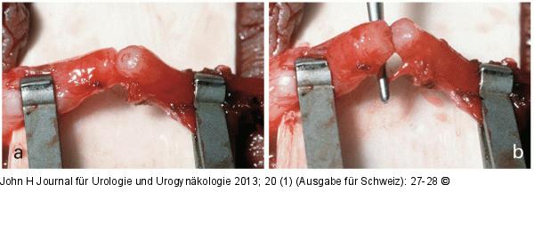 Mikroskopische Vasovasostomie