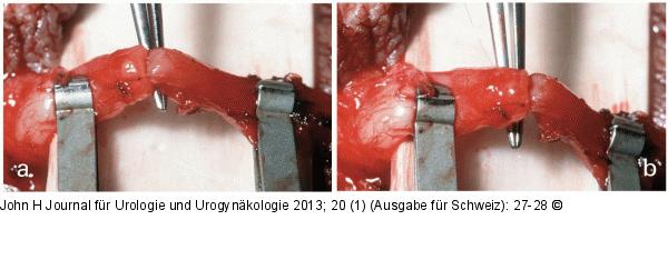 Mikroskopische Vasovasostomie
