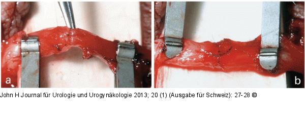 Mikroskopische Vasovasostomie