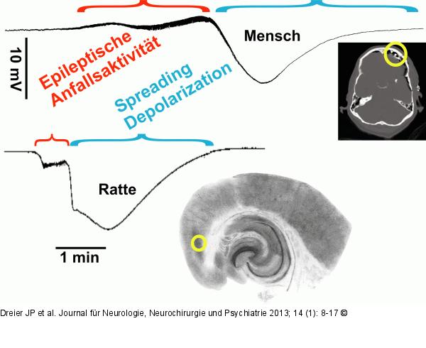 Spreading Depolarization - Mensch - Tier