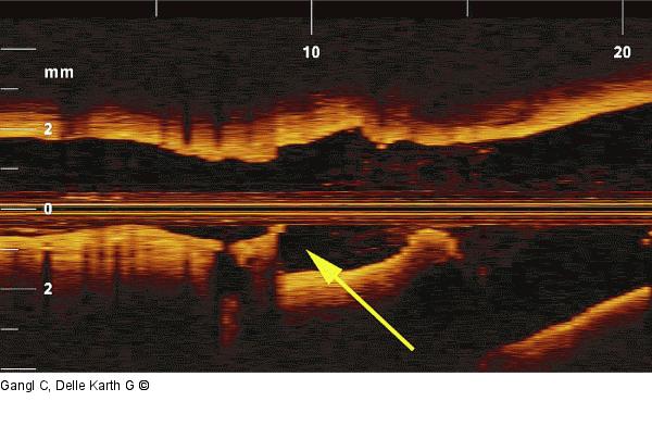 Stent-Gef-Mismatch