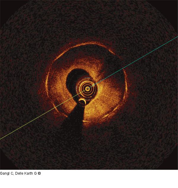 LASER-Angioplastie