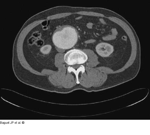 Aortenaneurysma