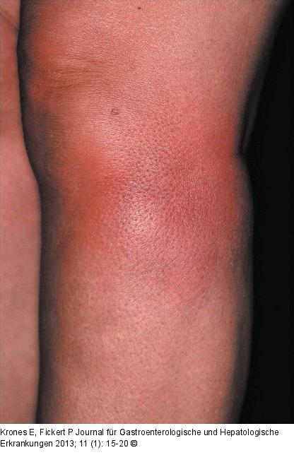 Erythema nodosum