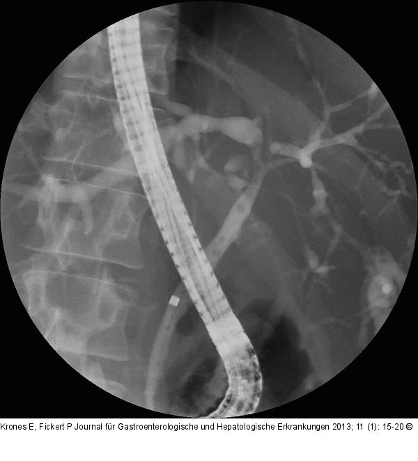 Cholangitis
