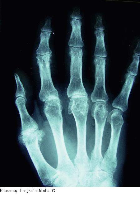 Arthropathie