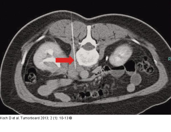 Lymphom