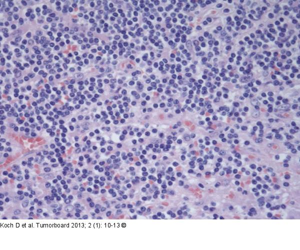 Lymphom