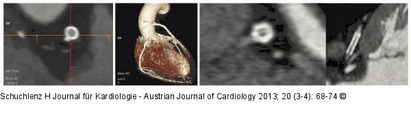 Herz-CT