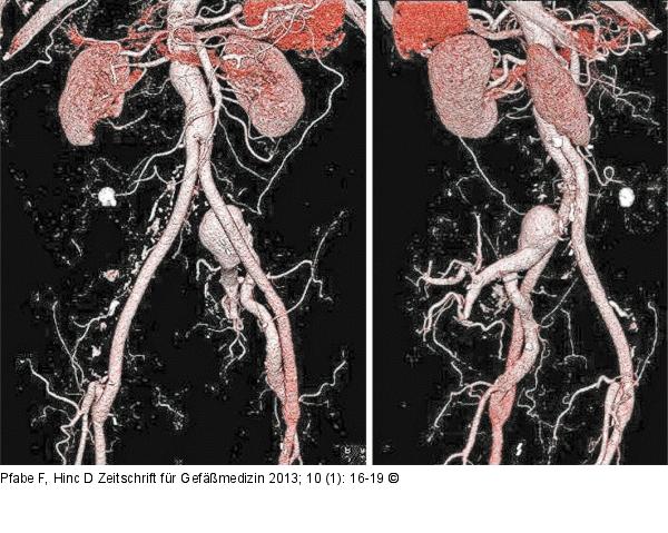 Iliaca-Aneurysma