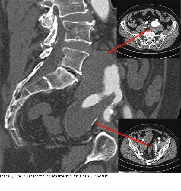 Iliaca-Aneurysma