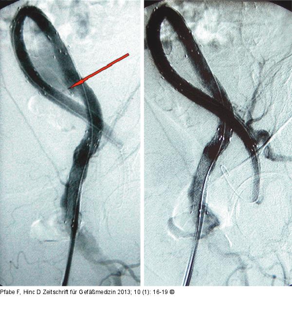 Iliaca-Aneurysma