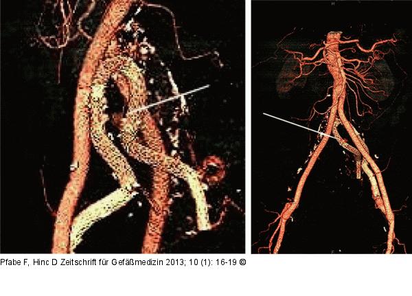 Iliaca-Aneurysma
