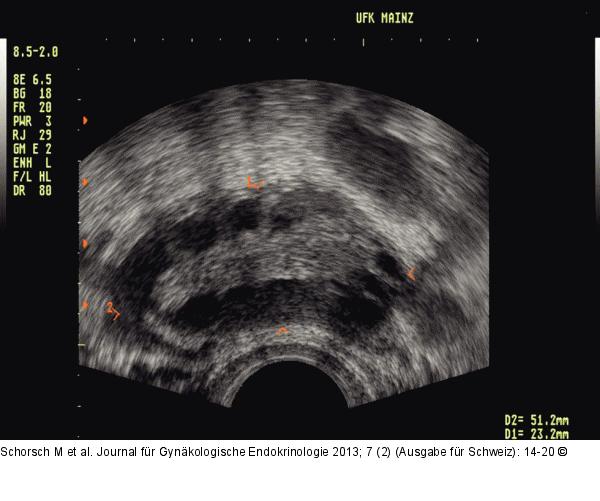 PCOS