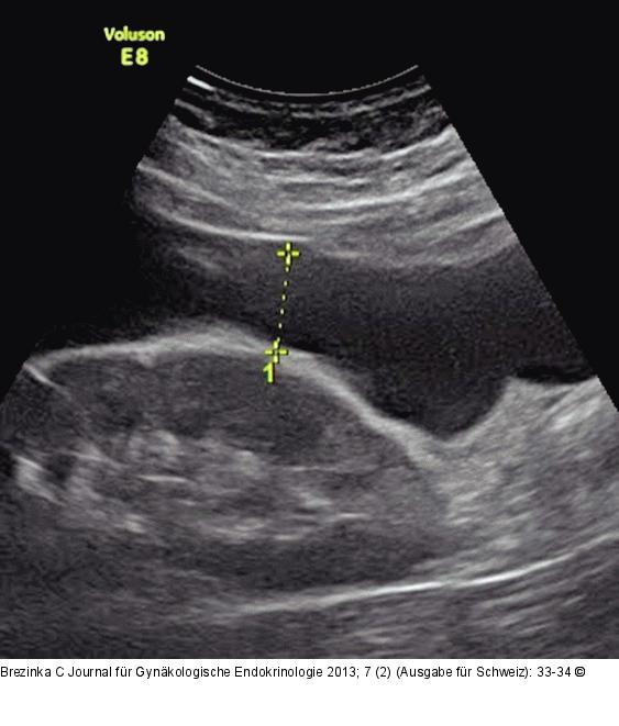 Gyn-Ultraschall