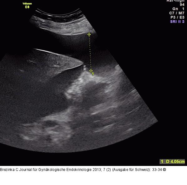 Gyn-Ultraschall