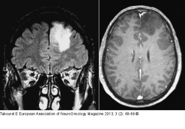 Brain MRI