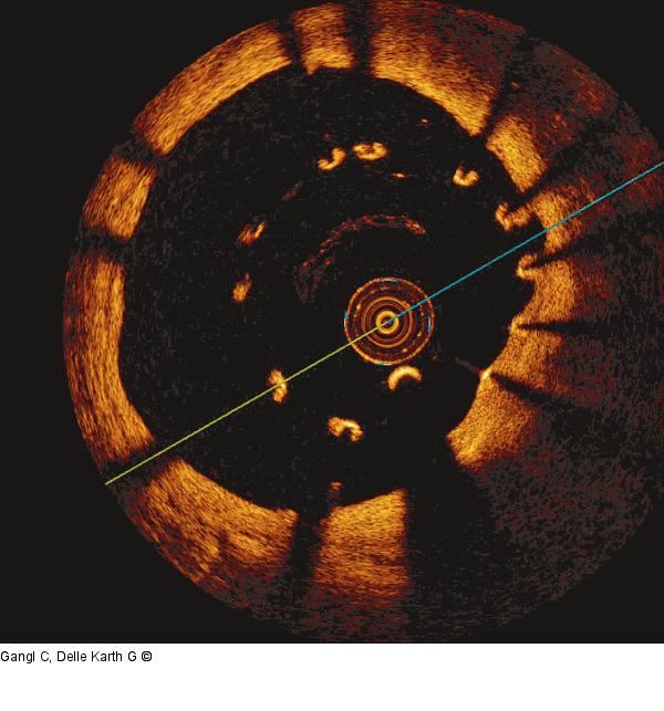Aneurysma