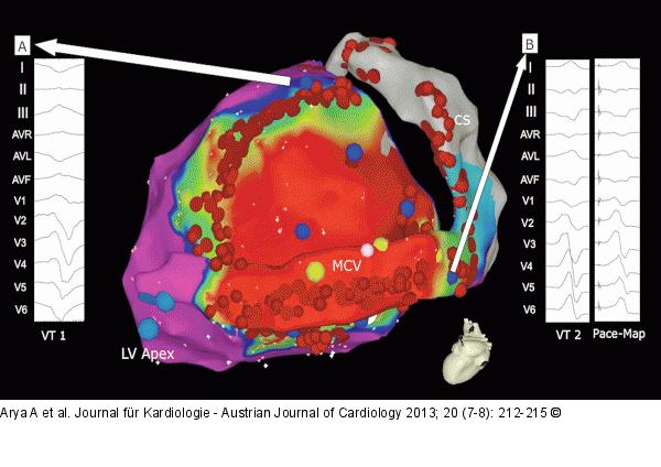 Catheter Ablation