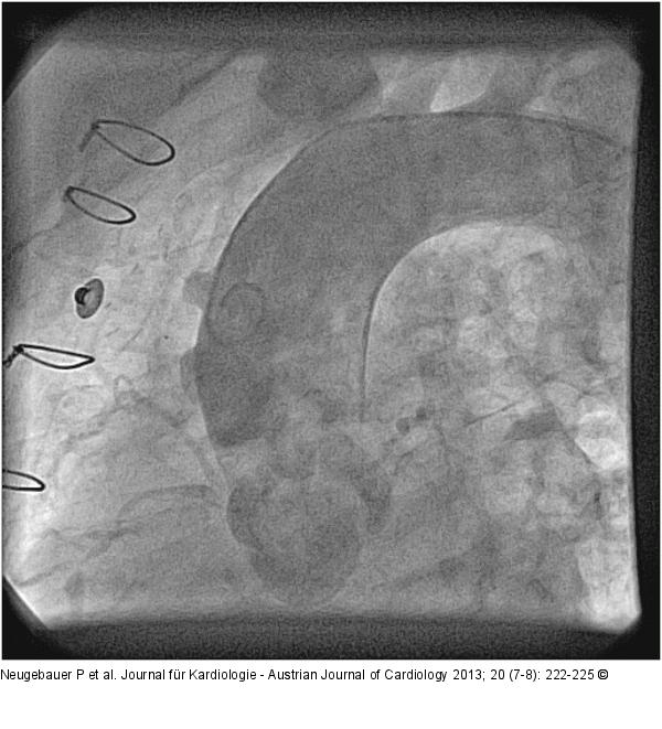 Catheter-Induced Dissection