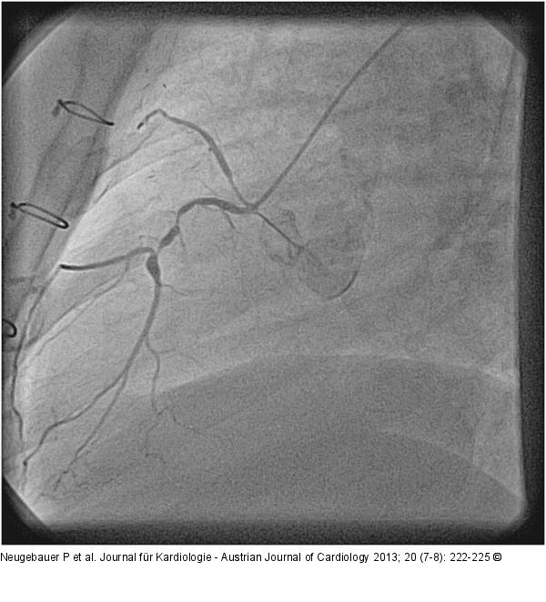 Catheter-Induced Dissection