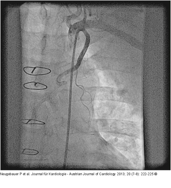 Catheter-Induced Dissection