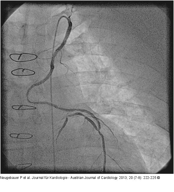 Catheter-Induced Dissection