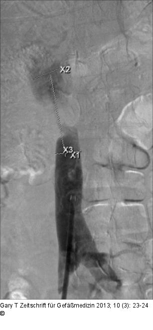 Venses Stenting