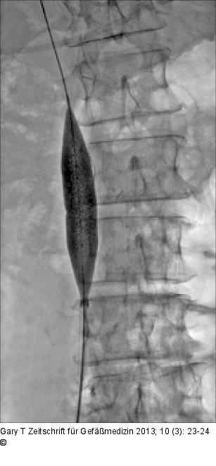 Venses Stenting