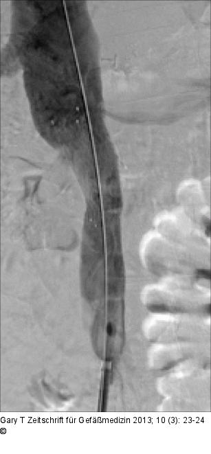 Venses Stenting