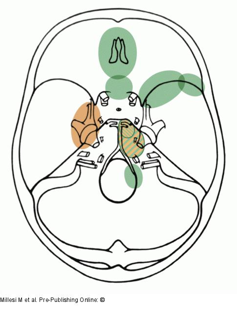 Intracranial Meningioma