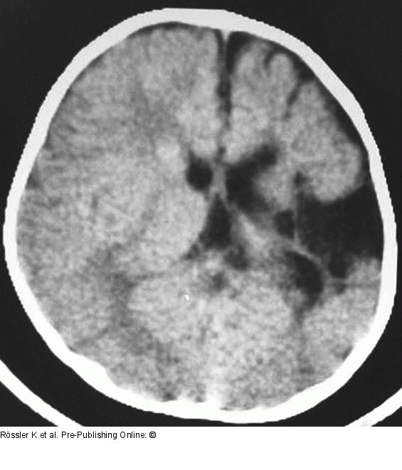 Brain-Collision-Tumour