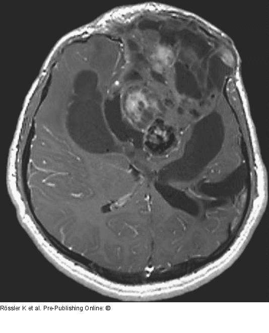 Brain-Collision-Tumour