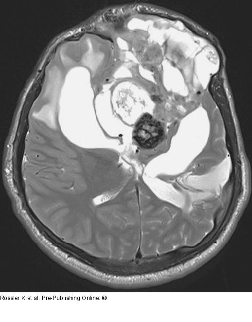 Brain-Collision-Tumour