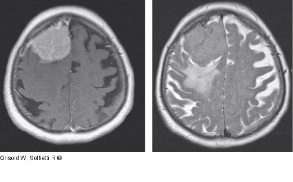 Meningeoma