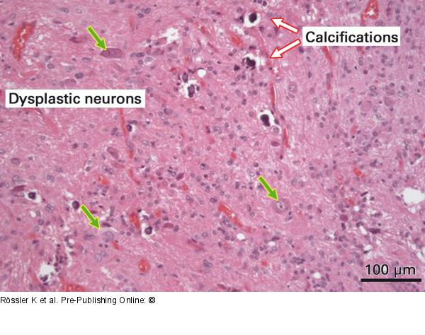 Brain-Collision-Tumour