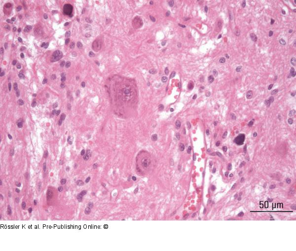 Brain-Collision-Tumour