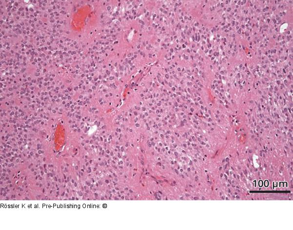 Brain-Collision-Tumour