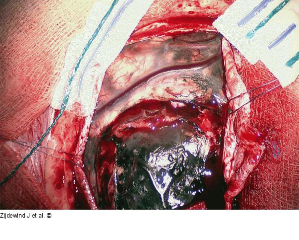 Leptomeningeal Tumour