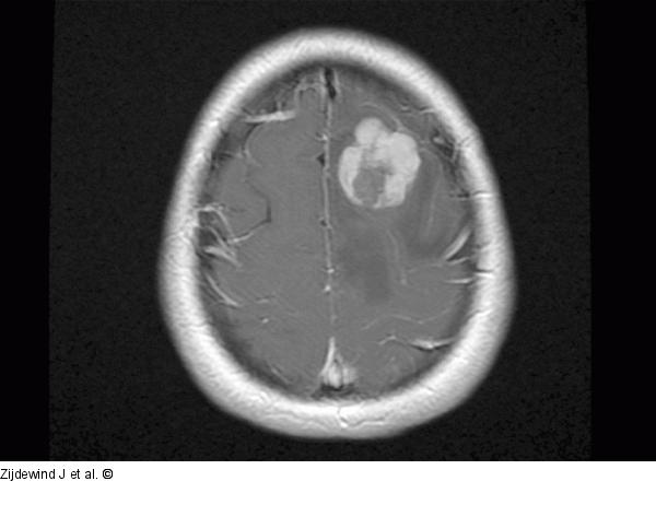 Leptomeningeal Tumour