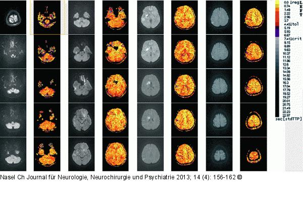 Schlaganfall-Neuroimaging