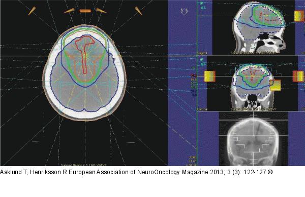 Radiotherapy - Meningioma