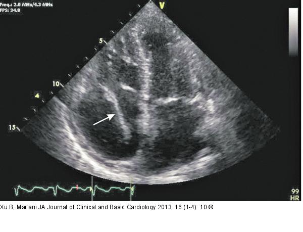 Transthoracic echocardiogram