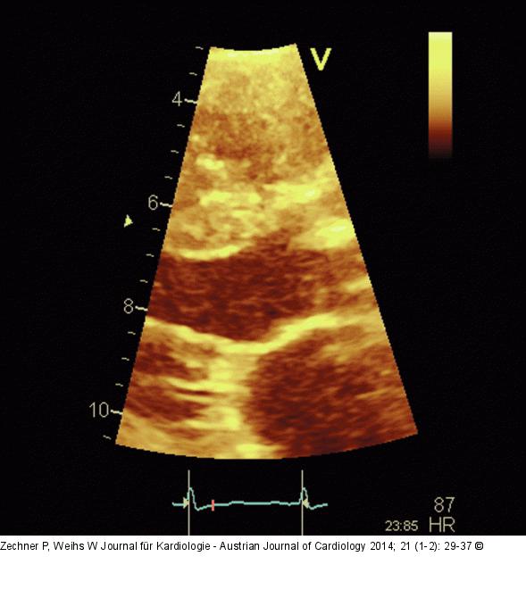 LVOT